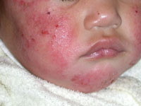 Atopic Dermatitis