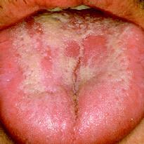 Candidiasis