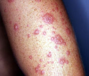 Erythema multiforme