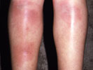 Erythema Nodosum